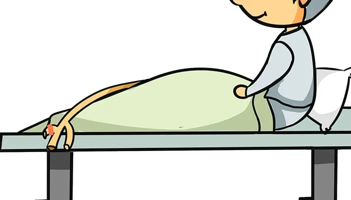 宝宝做完尿道下裂手术，多久能拔掉尿管？