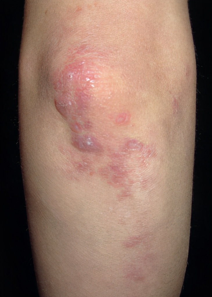 皮肌炎有什么样的皮肤改变?(1)