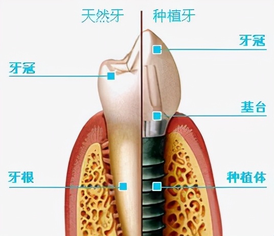 不同人群，缺牙装牙，活动假牙VS固定假牙，到底怎么选？