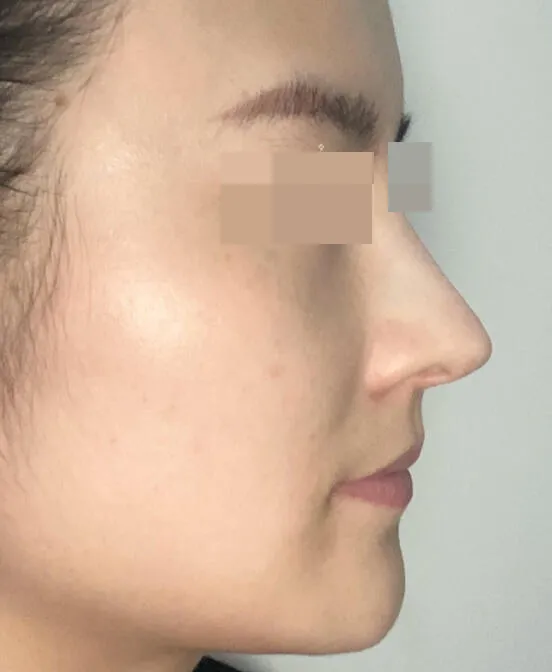 鼻子扁塌不美观,鼻梁过高同样也有烦恼?