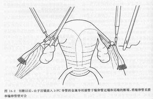 做过结扎现在还可以做回输卵管互通手术吗?