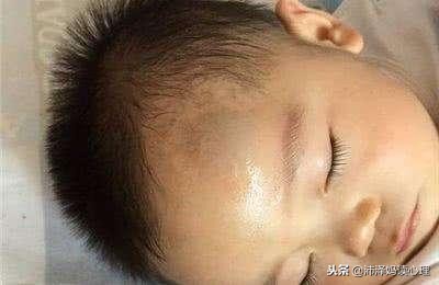 孩子头部碰撞起包如何快速消肿处理方法