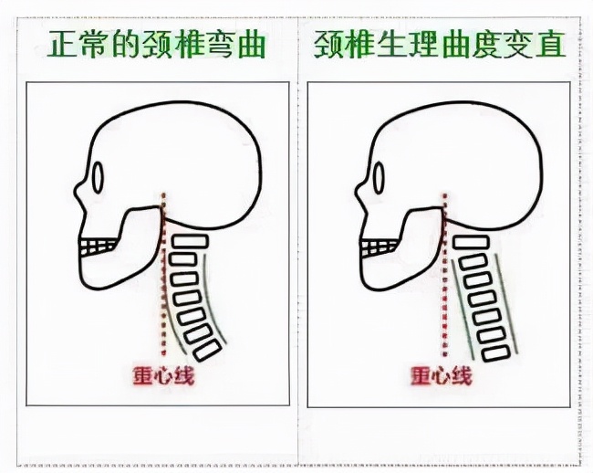 颈椎衰老分5个阶段，看看你到哪一步了？