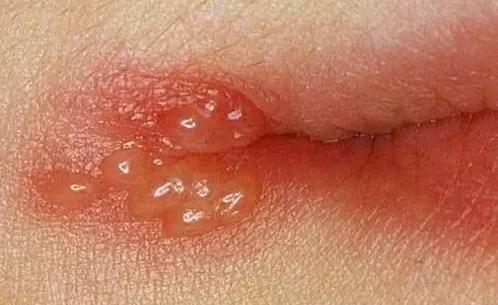你以为这是"上火"惹得祸,其实是口唇疱疹来敲门,本质是单纯疱疹病毒