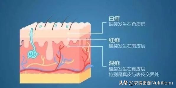 夏季如何分辨宝宝湿疹和痱子