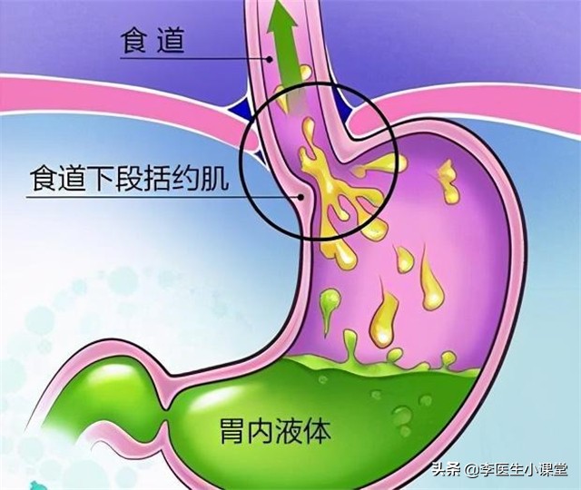 胃反酸烧心怎么办？经常反酸烧心的解决方法