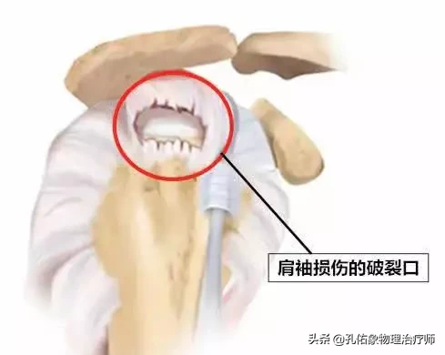 肩痛是不是肩周炎？医生教您如何从这10多种方法鉴别，请做好收藏