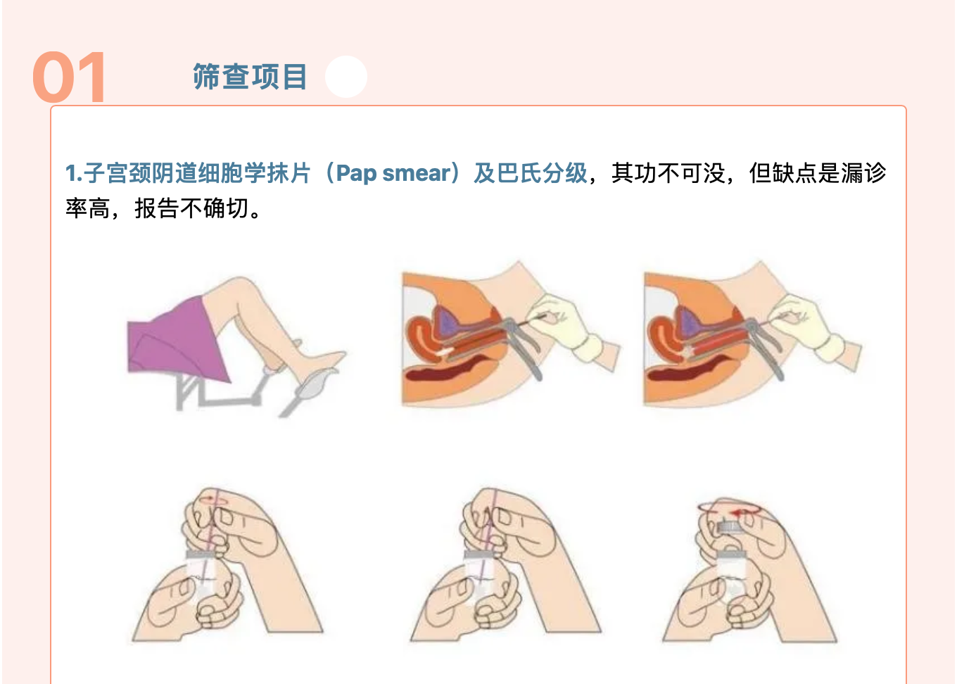 规范化筛查，远离宫颈肿瘤