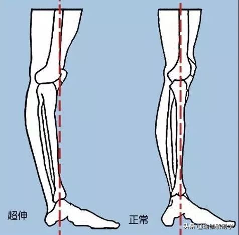 瑜伽体式中超伸是什么意思(练瑜伽，什么是超伸？超伸有什么危害，如何避免？)