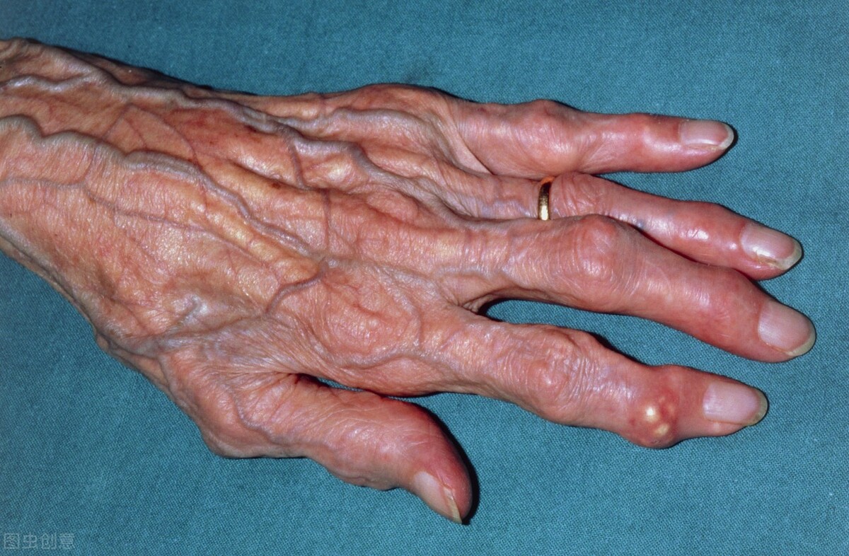 痛风石究竟能不能除去？医生：可以的，有4种方式可以选择