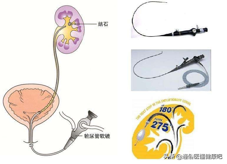 体外冲击波“碎石”和输尿管软镜“取石”，谁更“胜”一筹？