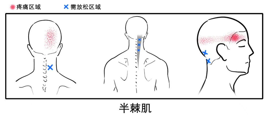 八成头痛和颈椎有关!一份“疼痛位置图解”帮你对症放松