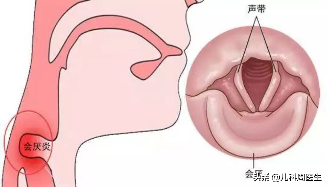 春季，不可轻视的犬吠样咳嗽、声嘶、喉鸣，预示着孩子喉炎高风险