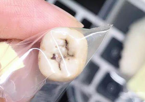 孩子的乳牙储存起来别扔，关键时候能救命？有条件没想的那么简单