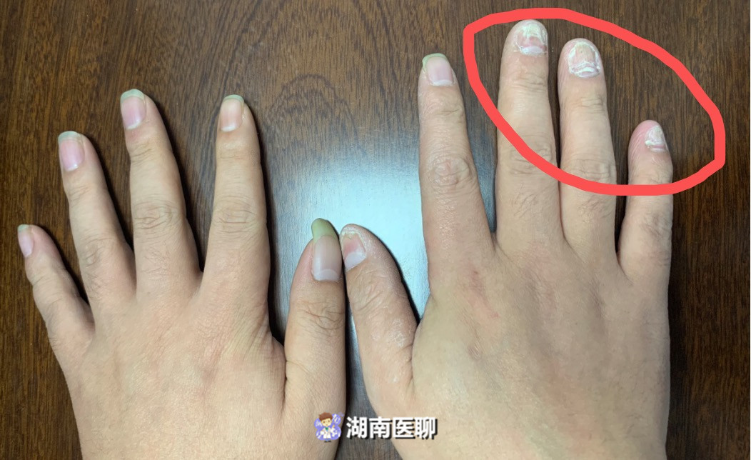 抠脚一时爽,一直抠脚一直爽?小心灰指甲