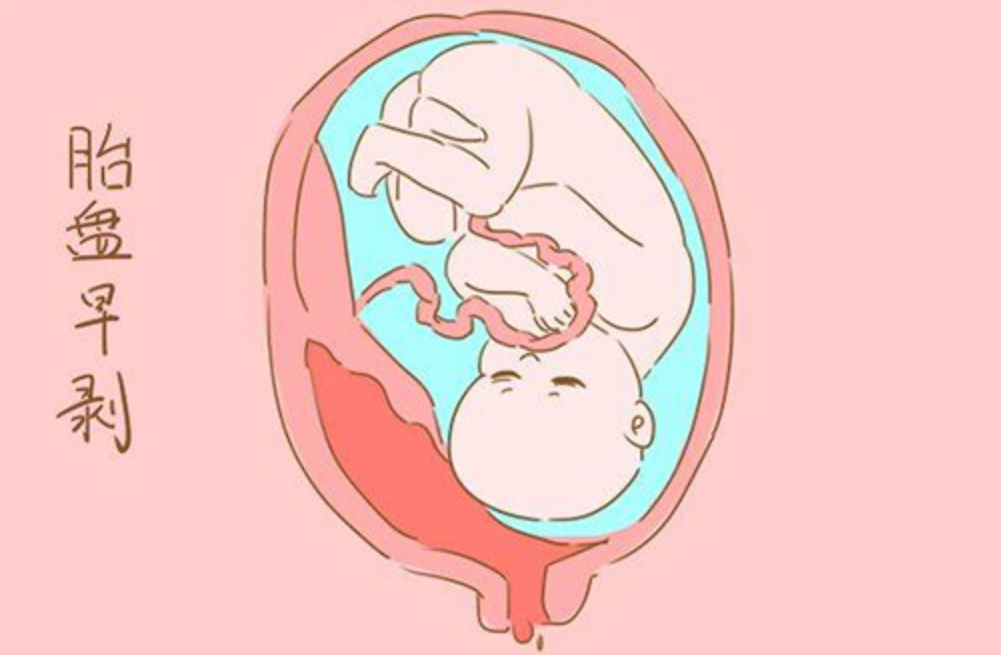 胎盘畸形图片