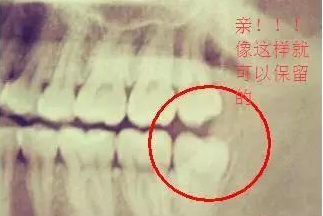 好消息，你的智齿长这样，就不用拔！你拔了吗？