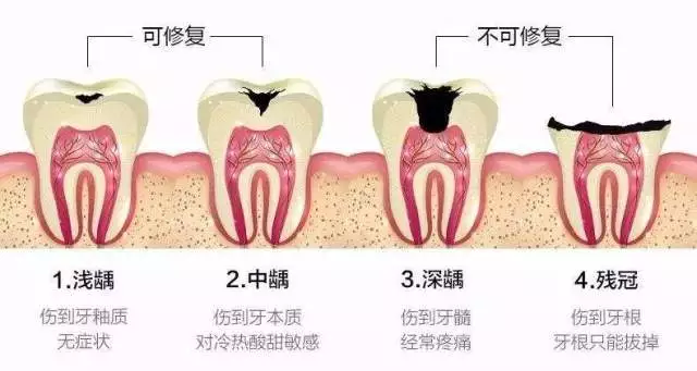 什么是牙齿打桩？什么是根管治疗？这篇建议收藏 #雅悦齿科#