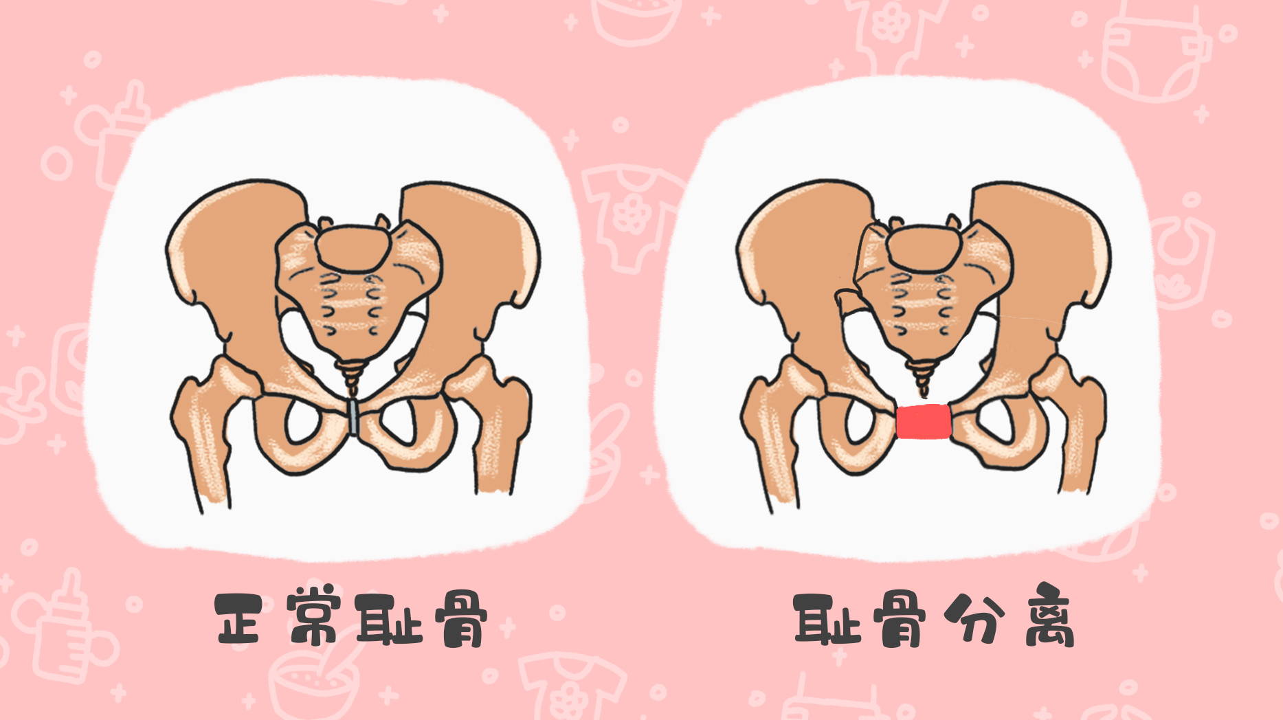 孕妇耻骨在哪个位置的图片(孕期有种"难熬"叫耻骨痛,这类孕妈更容易