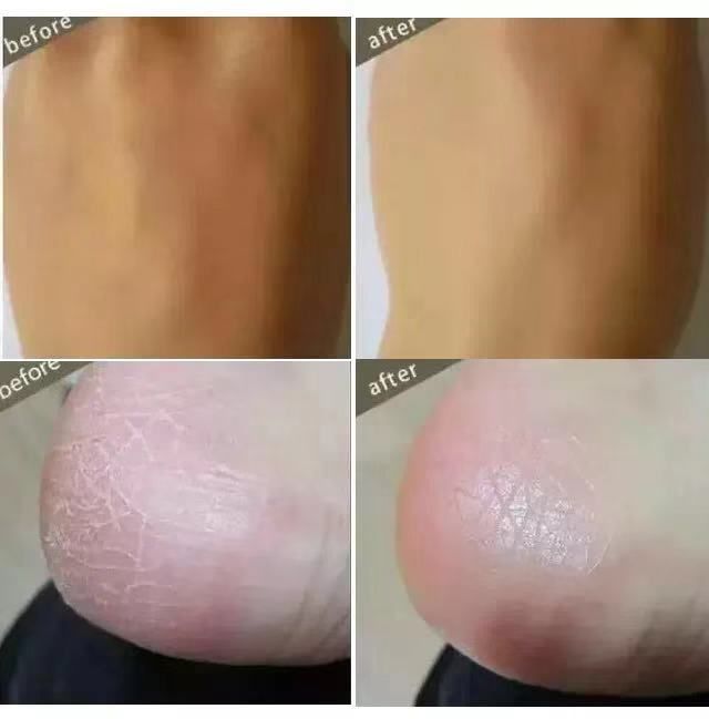 冬天一到，身体就干燥起皮？护肤达人教你一招，只需抹一下就好了