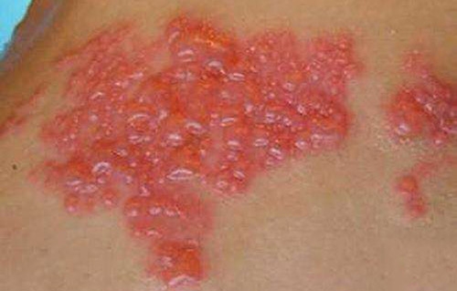 出现带状疱疹怎么办?医生整理6种药物治疗(附3种联合药物治疗)