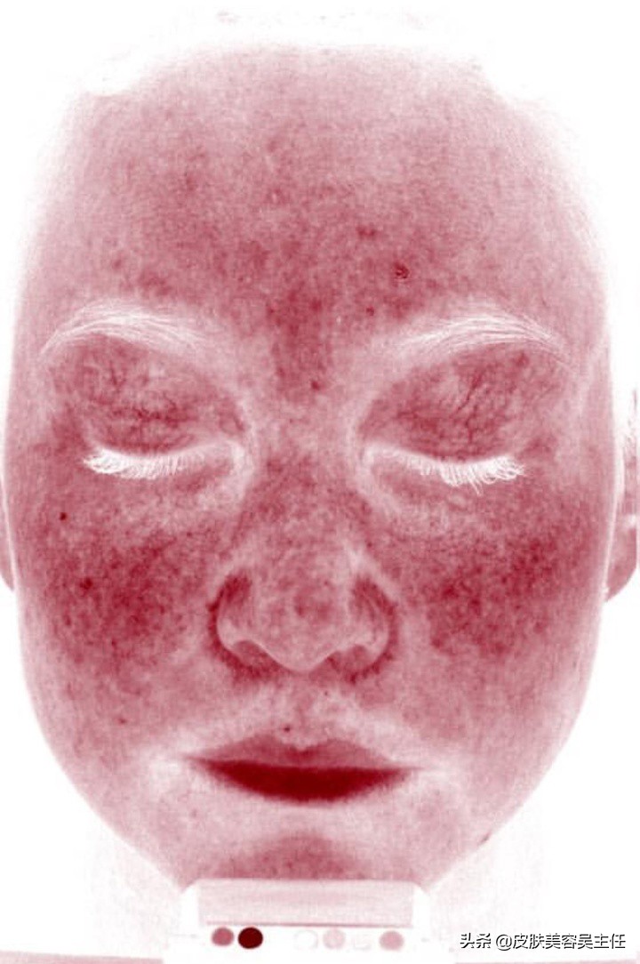 如何看待检测皮肤的visia检测结果？