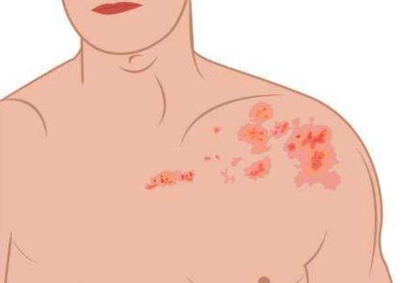 缠腰丹初期症状图片(脚上长水泡了) - 赤虎壹号