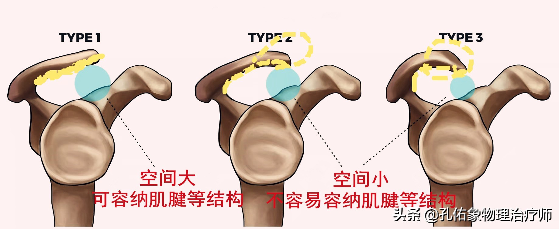 肩周炎是导致肩痛的原因，结果大家都进入误区，咋不想想其他病因