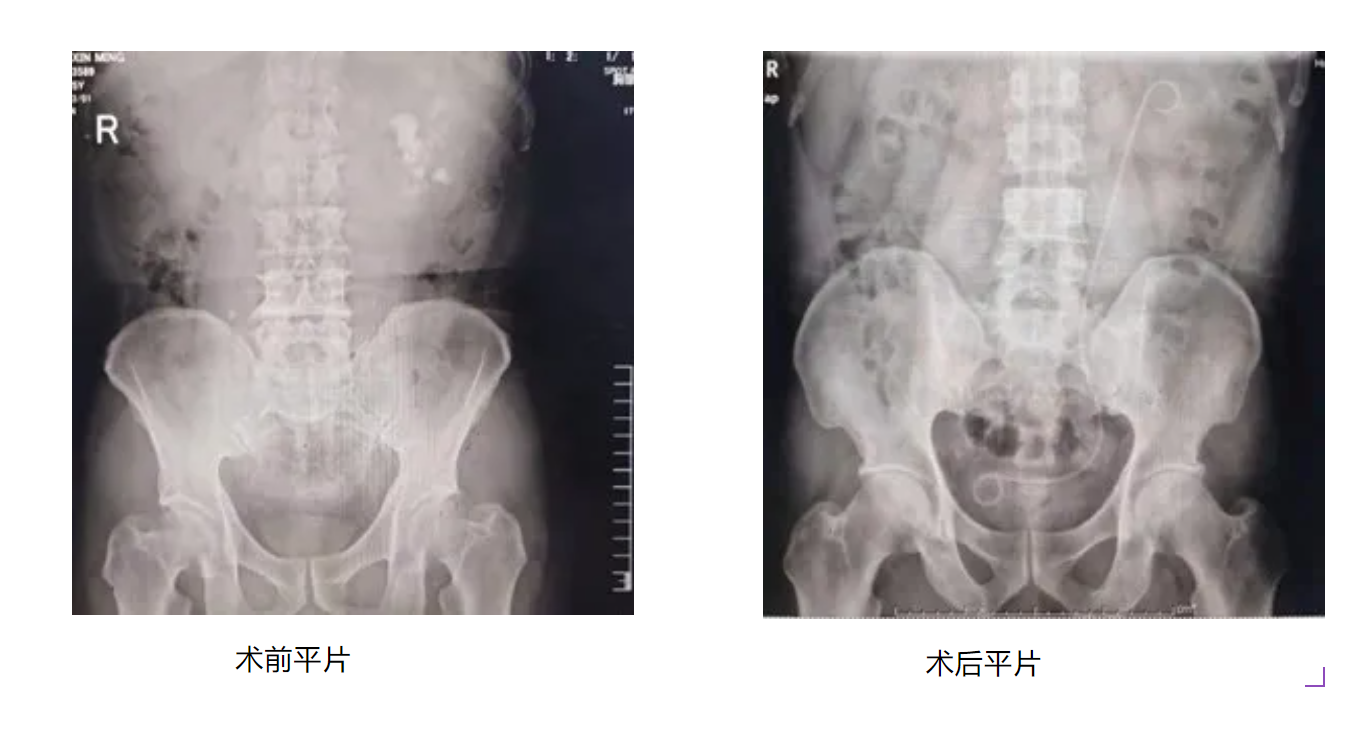 不开刀、不“打洞”！搞定肾结石，其实还可以这样做