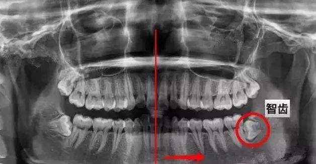 疼不疼的我不管，反正横着长的智齿必须拔