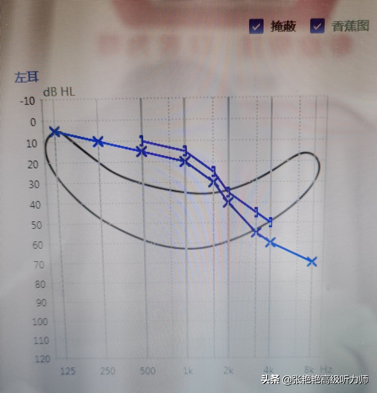 耳聋越重，配的助听器越贵？轻的话配个便宜的就行？看专家怎么说