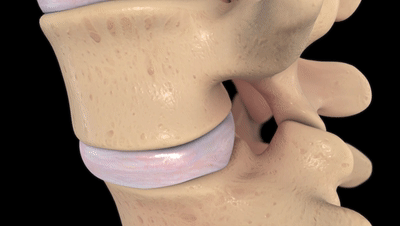 6个缓解腰椎间盘突出的伸展运动，避免7个训练，强壮腰椎不踩雷