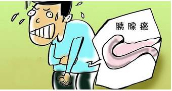 胰腺癌的致病因素及为何被称为癌中之王