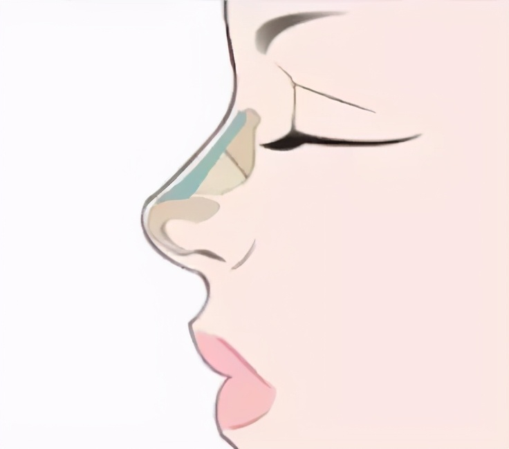 鼻子不仅扁还短，应该如何改善？