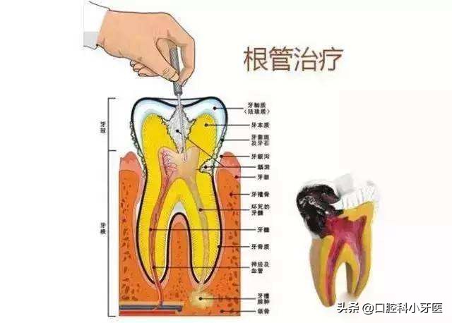 牙齿疼痛难忍口腔医生诊断牙髓炎，牙髓炎症可以消炎治疗吗？