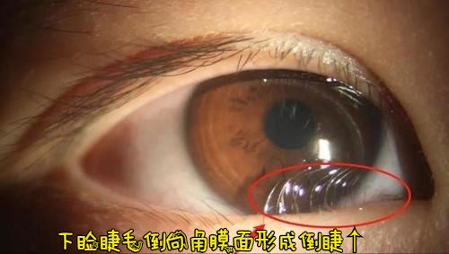 若经常感觉眼睛有异物感、流泪，有倒刺的感觉，那可能长倒睫毛了