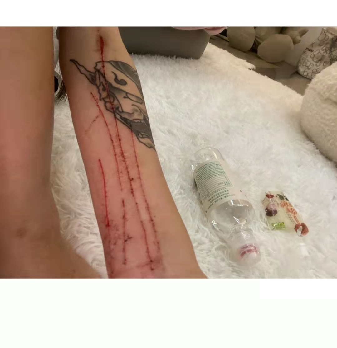 她还晒出了自残的照片,她的腿上,胳膊上,脖子上满是伤痕,看上去有些