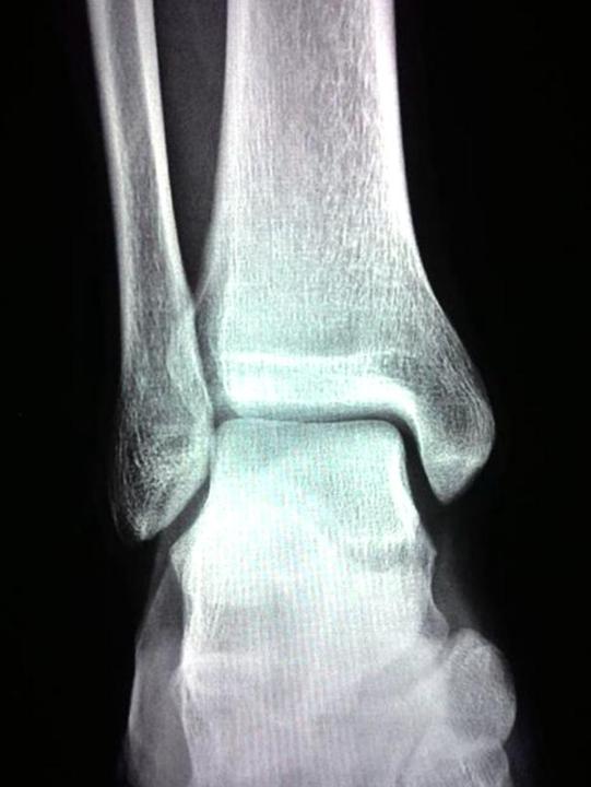 走路时，膝盖突然“软”一下，是咋回事？医生告诉你真相，要留心