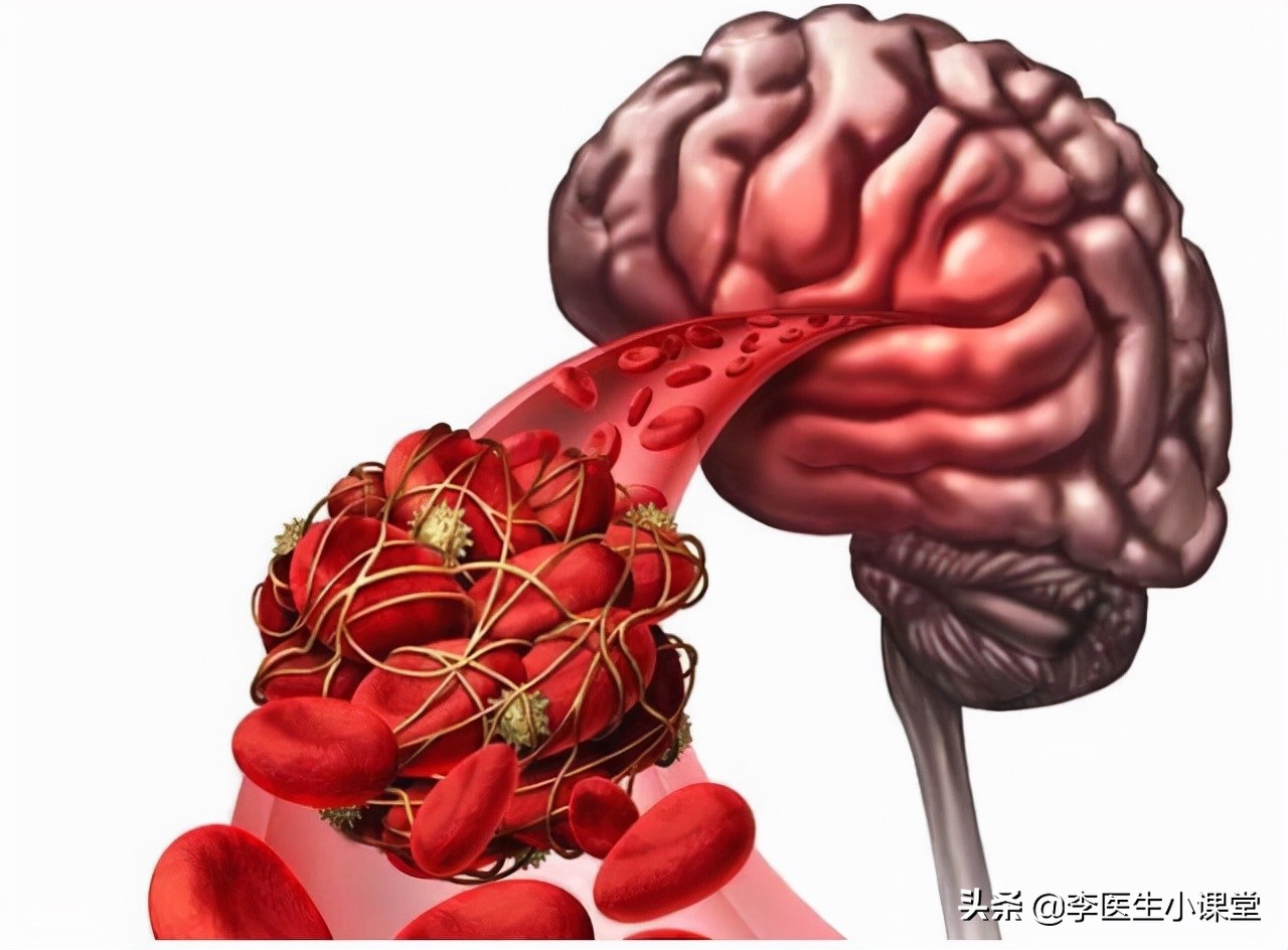 脑供血不足如何改善？有效治疗方法与日常调理要点