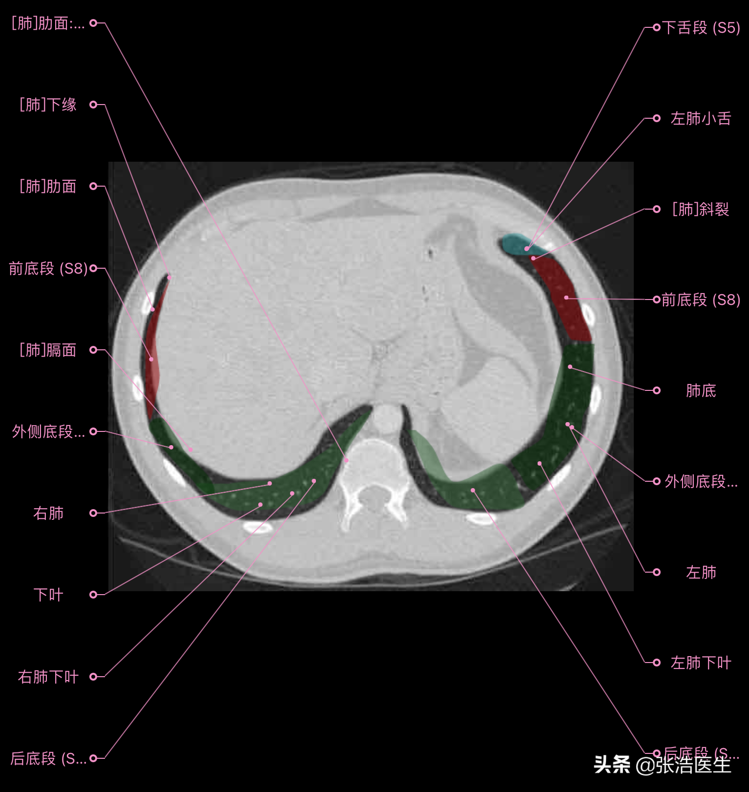肺部ct高清解剖图谱,附带详细标注