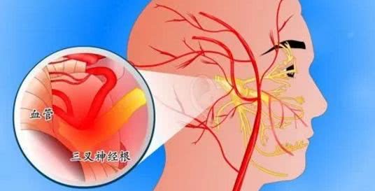 厦门一男子拔牙6颗，牙痛依旧，一查竟是“天下第一痛”惹的祸