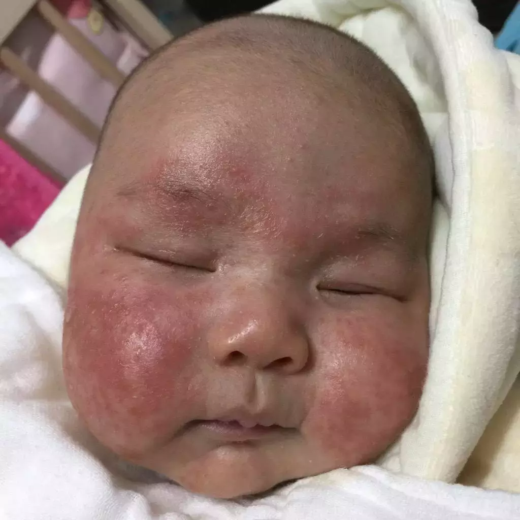 婴儿湿疹-常见皮肤病-医学