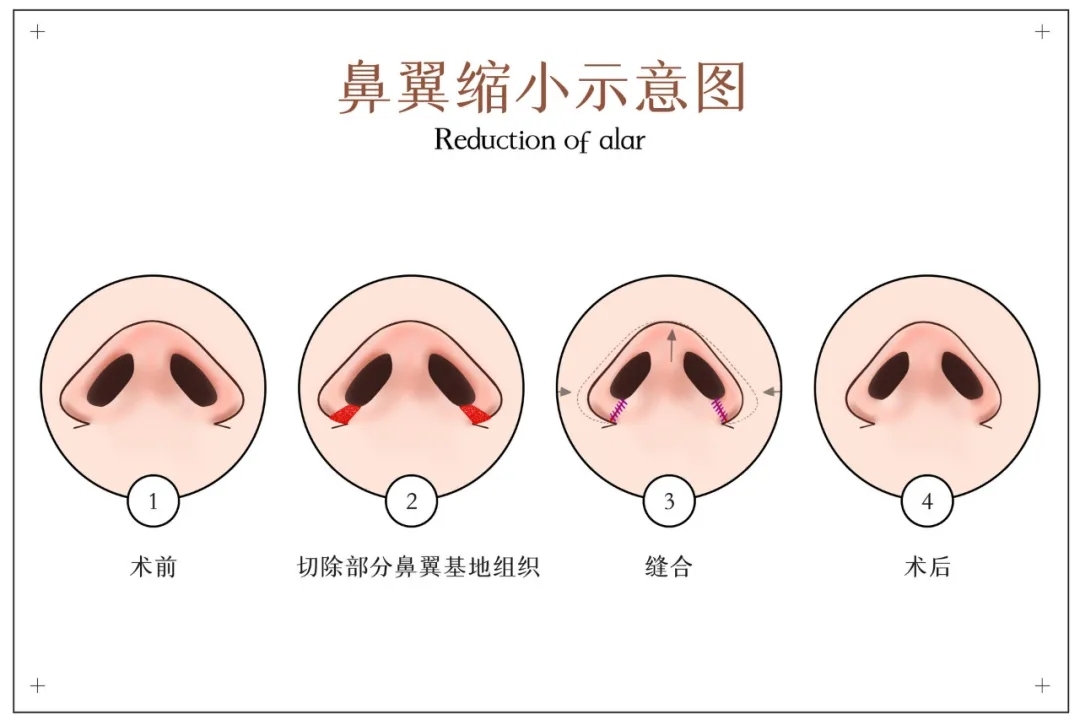 「涨点姿势」三种宽鼻子的解决办法