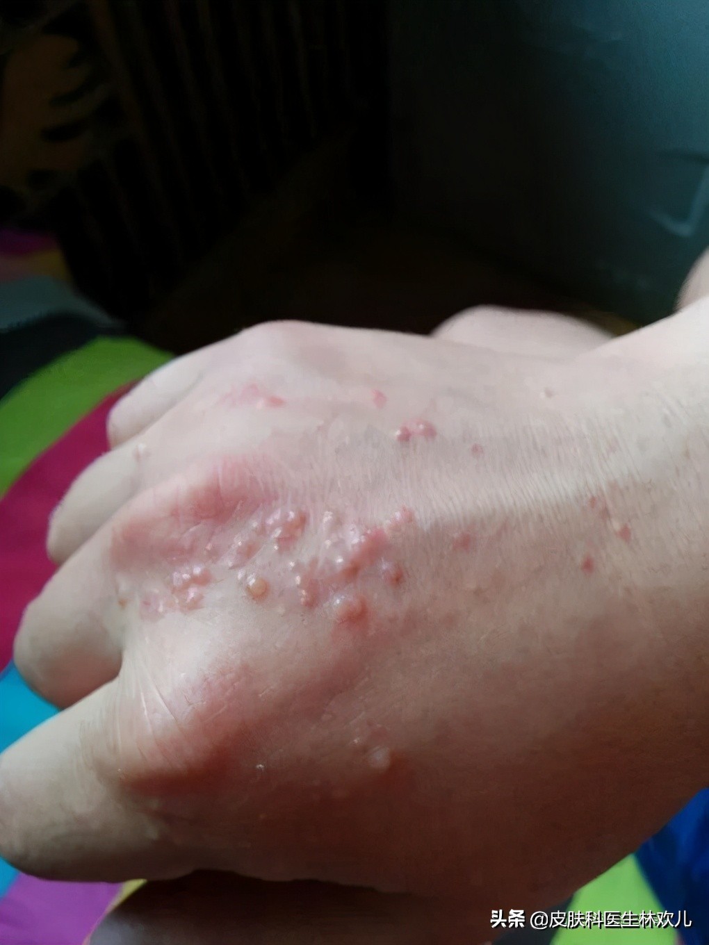 「手部湿疹」你是否也有这样的社交障碍手?