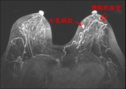 乳腺疾病常用的检查方法和治疗手段有哪些？看这篇文章你就明白了