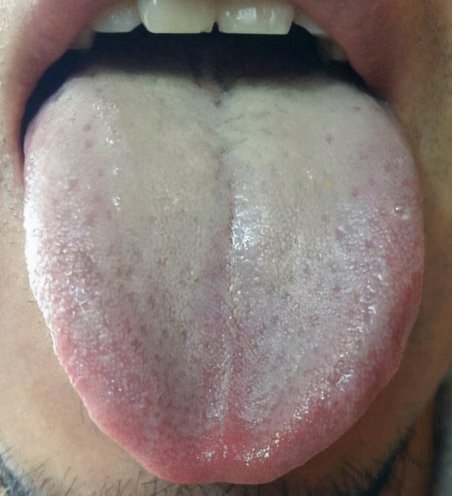 舌苔发黄的原因有哪些图片
