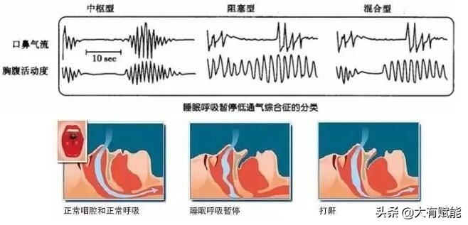 全面解析睡眠呼吸暂停
