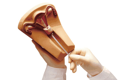 宫颈变紧,而节育环却不会随之变小,若不及时取出,便会造成取环困难