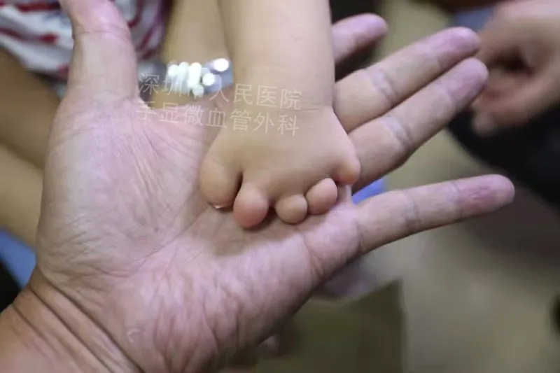 得了这病，12岁男孩手指比香蕉还粗！7种常见的手部畸形，家长们要注意