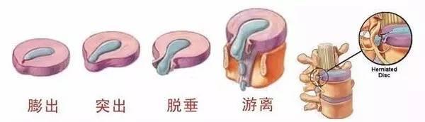 6个缓解腰椎间盘突出的伸展运动，避免7个训练，强壮腰椎不踩雷